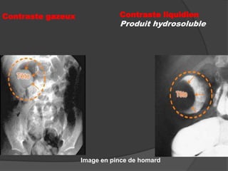 Contraste gazeux

Contraste liquidien

Produit hydrosoluble

Image en pince de homard

 
