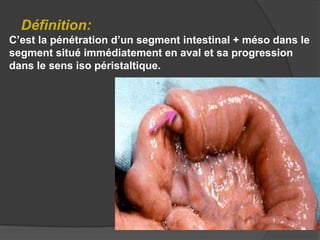 Définition:
C’est la pénétration d’un segment intestinal + méso dans le
segment situé immédiatement en aval et sa progression
dans le sens iso péristaltique.

 