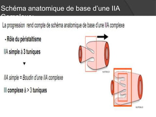 Schéma anatomique de base d’une IIA
Complexe:

 