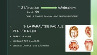 z
2-L’éruption
cutanée
DANS LA ZONEDE RAMSAY HUNT PARFOIS BUCCALE
 3- LA PARALYSIE FACIALE
PERIPHERIQUE
 APRES 3 -5 JOURS
 MAXIMALE AU 3 éme JOUR .
 ELLE EST COMPLETE DS 50% des cas
Vésiculaire
 