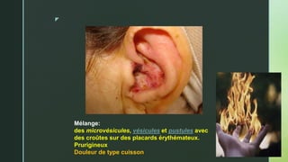 z
Mélange:
des microvésicules, vésicules et pustules avec
des croûtes sur des placards érythémateux.
Prurigineux
Douleur de type cuisson
 