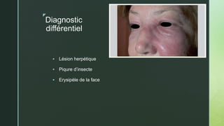 z
Diagnostic
différentiel
 Lésion herpétique
 Piqure d’insecte
 Erysipèle de la face
 
