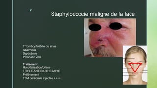 z
Staphylococcie maligne de la face
Thrombophlébite du sinus
caverneux
Septicémie
Pronostic vital
Traitement :
Hospitalisation/bilans
TRIPLE ANTIBIOTHERAPIE
Prélèvement
TDM cérébrale injectée ++++
 