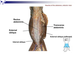 External oblique (reflected)
Rectus
abdominis
Transverse
abdominis
External
oblique
Internal oblique
 