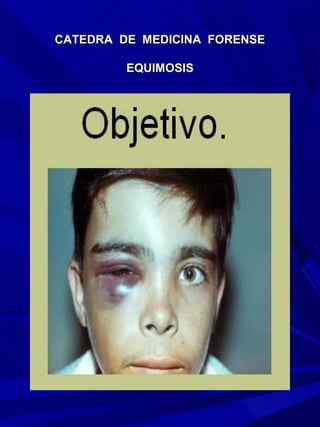 CATEDRA DE MEDICINA FORENSE

         EQUIMOSIS
 