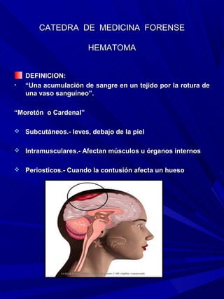 CATEDRA DE MEDICINA FORENSE

                       HEMATOMA


    DEFINICION:
•   “Una acumulación de sangre en un tejido por la rotura de
    una vaso sanguíneo”.

“Moretón o Cardenal”

 Subcutáneos.- leves, debajo de la piel


 Intramusculares.- Afectan músculos u órganos internos


 Periosticos.- Cuando la contusión afecta un hueso
 