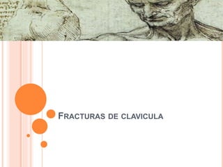FRACTURAS DE CLAVICULA
 
