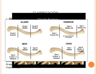 CLASIFICACIÓN
 Clasificación descriptiva (descripción anatómica de localización,
desplazamiento, angulación, patrón y conminución)
 Clasificación de Allman
 Grupo I: tercio medio (80%)
 Grupo II: tercio distal (15%)
-mínimamente desplazadas : foco entre ligamentos coracoclaviculares con
ellos intactos
-desplazamiento secundario a una fractura medial a los ligamentos ( A: los
ligamentos permanecen unidos al segmento distal, B: fractura del conoide
permanece el trapezoide)
-fractura de superficie acromioclavicular sin lesion de ligamentos
o Grupo III:del tercio proximal (5%)
Cinco tipos
I-minimo deplazamiento
II- desplazadas
III-intraarticulares
IV-separación epifisaria
V-conminutas
 