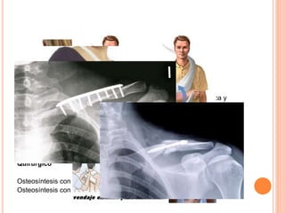 TRATAMIENTO
No quirúrgico
-yeso en 8
-vendaje en 8
-cabestrillo
Duración: 4-6 semanas con movimientos de rango de codo, muñeca y
mano
Seguimiento: controles rx para valorar eventuales desplazamientos
posteriores
Secuelas: acortamiento y deformidad (mínimas)
Quirúrgico
Osteosíntesis con placa y tornillos
Osteosíntesis con clavo intramedular
 