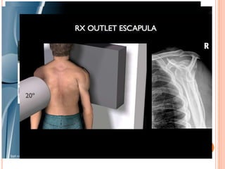 IMÁGENES
 Radiografías
Tórax frente
Hombro AP
Axilar de escapula
Proyección lateral
Proyección de la escotadura de stryker
(valora coracoides) en 45° de desviacion cefálica
 TAC
(lesiones asociadas)
 