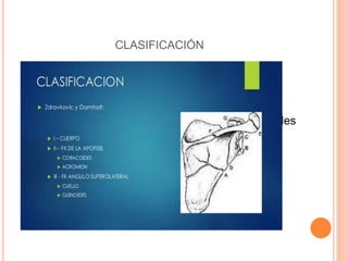 CLASIFICACIÓN
 Anatómica de Damholt
 Tipo I cuerpo de escapula
 Tipo II apófisis incluyendo el acromion y coracoides
 Tipo III fx del angulo superolateral incluyendo
glenoides y cuello
 