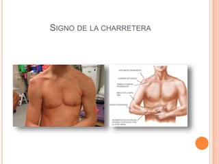 SIGNO DE LA CHARRETERA
 