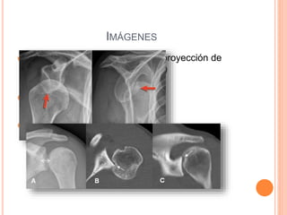 IMÁGENES
 Radiografias : anteroposterior y proyección de
Velpeau (útil cuando existe dolor)
 Tomografia (fracturas asociadas)
 Resonancia Nuclear Magnética
 