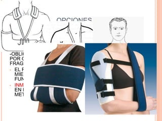 OPCIONES
 YESO COLGANTE: USA EL PESO DEL MISMO PARA
DISTRACCION Y REDUCCION DE FRACTURA
-FRACTURAS DE PORCION MEDIA
-ESPIROIDEAS U OBLICUAS
-OBLICUA CORTA Y TRANSVERSA SON CI RELATIVAS
POR QUE PUEDEN DISTRACCIONAR LOS
FRAGMENTOS (RETARDO/PSEUDOARTROSIS)
• EL PACIENTE DEBE PERMANECER CON EL
MIEMBRO PENDIENTE TODO EL TIEMPO PARA QUE
FUNCIONE
• INMOVILIZACION TORACOBRAQUIAL (VELPEAU):
EN NIÑOS Y ANCIANOS QUE NO TOLERAN OTRO
METODO-FX QUE NO NECESITAN REDUCION,
 