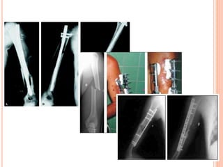 TECNICAS
 RAFI
 FIJACION INTRAMEDULAR
 FIJADOR EXTERNO
 