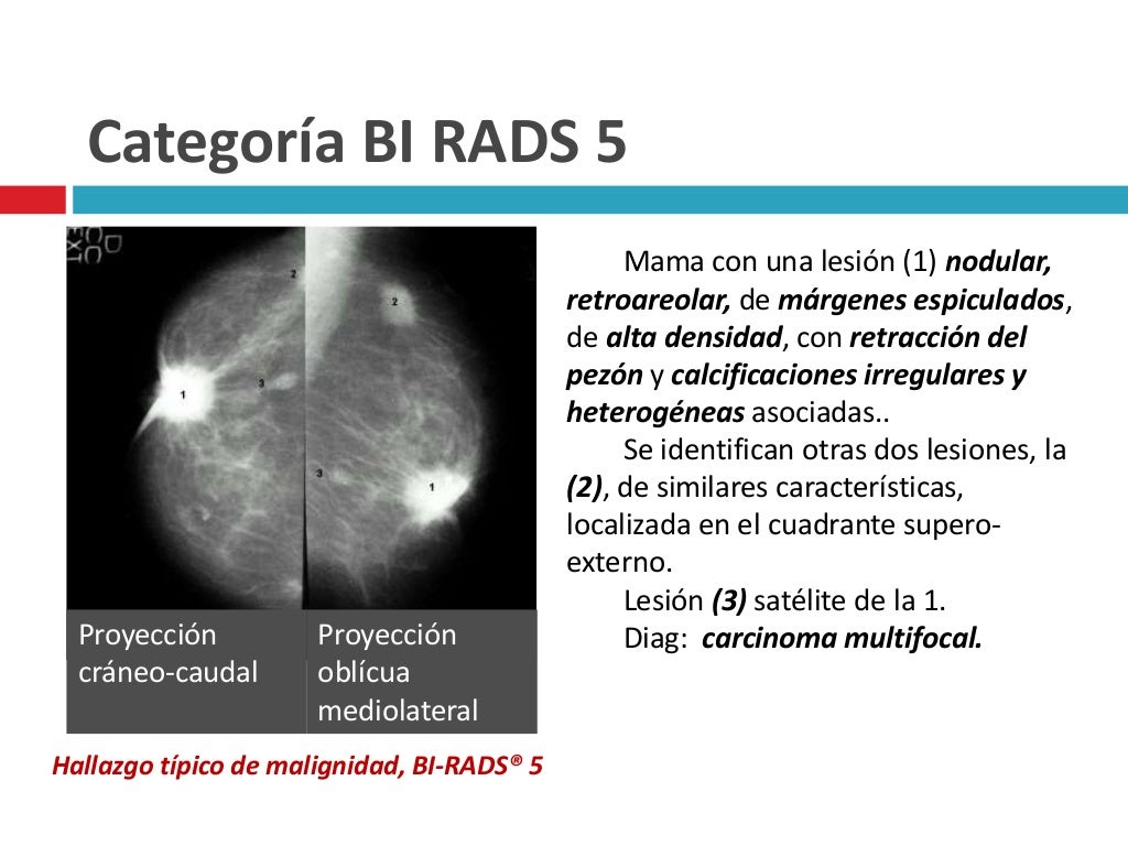 Categorías bi rads en los informes mamográficos Categorías bi rads en los informes mamográficos