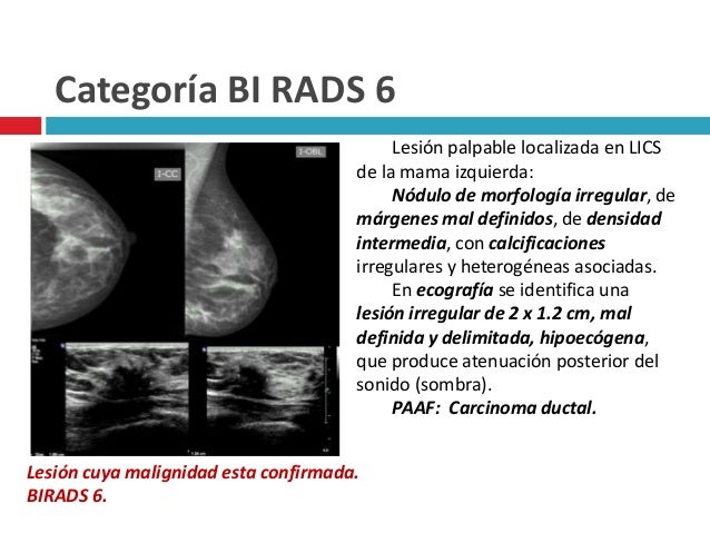 Что значит категория bi rads. Birads 1 молочной железы что это такое. Birads классификация в УЗИ. Правая железа категория bi-rads: 2. Маммография классификация bi-rads.
