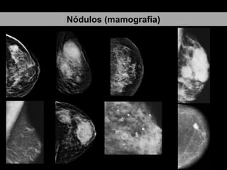 Nódulos (mamografía)
 