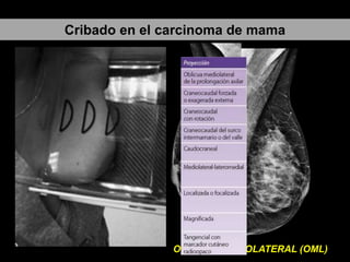 Otras proyecciones:
Compresión
Lateral
OBLICUO MEDIOLATERAL (OML)
Cribado en el carcinoma de mama
 