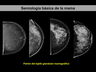 Semiología básica de la mama

Patrón del tejido glandular mamográfico

 