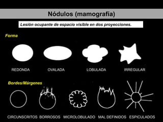 Nódulos (mamografía)
Lesión ocupante de espacio visible en dos proyecciones.
Forma

REDONDA

OVALADA

LOBULADA

IRREGULAR

Bordes/Márgenes

CIRCUNSCRITOS BORROSOS MICROLOBULADO MAL DEFINIDOS ESPICULADOS

 
