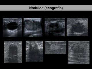 Nódulos (ecografía)

 