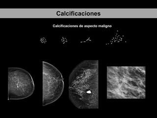 Calcificaciones
Calcificaciones de aspecto maligno

 