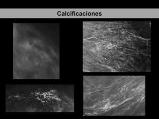 Calcificaciones

 