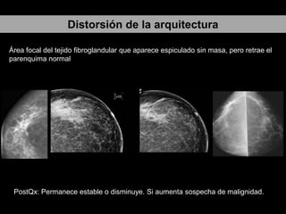 Distorsión de la arquitectura
Área focal del tejido fibroglandular que aparece espiculado sin masa, pero retrae el
parenquima normal

PostQx: Permanece estable o disminuye. Si aumenta sospecha de malignidad.

 