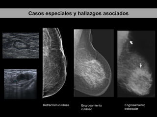 Casos especiales y hallazgos asociados

Retracción cutánea

Engrosamiento
cutáneo

Engrosamiento
trabecular

 