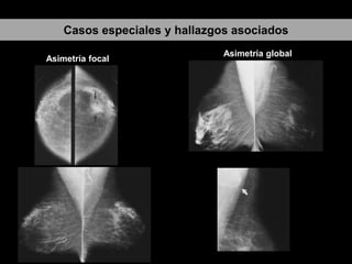 Casos especiales y hallazgos asociados
Asimetría focal

Asimetría global

 