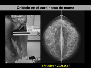 Cribado en el carcinoma de mama

Población diana (mujeres asintomáticas 45-69 años).
PROYECCIONES

CRANEOCAUDAL (CC)

 