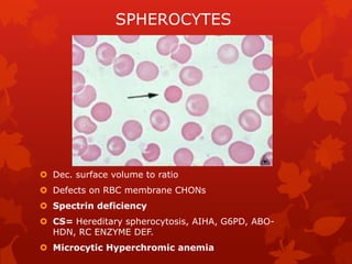 ECHINOCYTES (CRENATED RBC)

 Short equally spaced projections, regular spicules
 Present in prolonged standing artifacts...