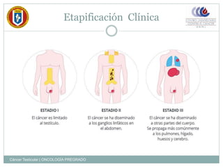 Etapificación Clínica
Cáncer Testicular | ONCOLOGÍA PREGRADO
 