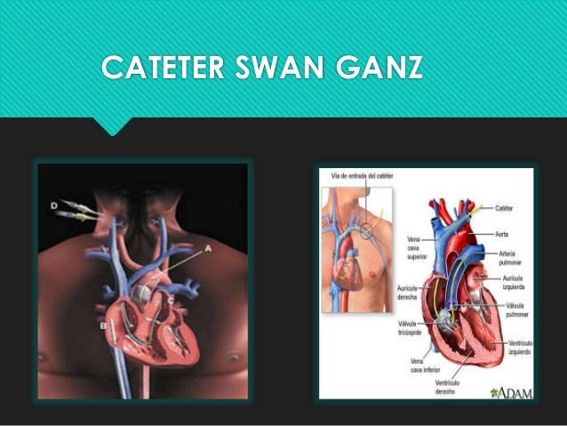 Cateter Swan Ganz