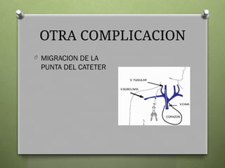 OTRA COMPLICACION
O MIGRACION DE LA
PUNTA DEL CATETER
 