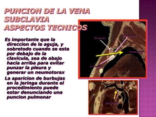Subclavia V.
Es importante que la
                                Clavicula

 direccion de la aguja, y
 sobretodo cuando se esta                                      Neumotorax
 por debajo de la
 clavicula, sea de abajo
 hacia arriba para evitar
 punzar la pleura y         1st Costilla

 generar un neumotorax
La aparicion de burbujas
 en la jeringa durante el
 procedimiento puede
 estar denunciando una
 puncion pulmonar
                                           Subclavia V.
 