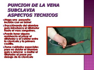 Haga    una pequeña
 incisión con un bisturi
Tracciónando del alambre
 guía introduzca el dilatador
 hasta el vaso sanguíneo.
Puede tener alguna
 resistencia al pasar el
 dilatador o el catéter entre
 la clavícula y la primera
 costilla.
Tome cuidados especiales
 para no doblar el alambre
 guía o retorcer o mellar el
 dilatador al pasar por
 debajo de la clavicula
 