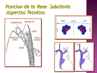 Puncion de la Vena Subclavia
Aspectos Tecnicos
 