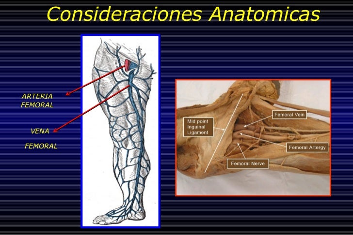 CATETERES