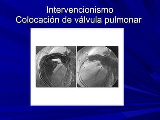 Intervencionismo Colocación de válvula pulmonar  