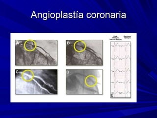 Angioplastía coronaria 