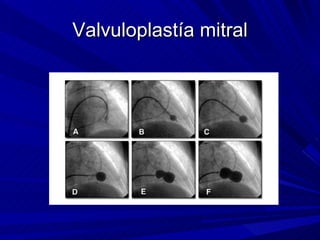 Valvuloplastía mitral 