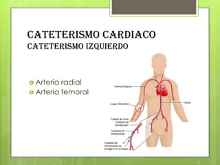 CATETERISMO CARDIACO
cateterismo izquierdo

 Arteria

radial
 Arteria femoral

 