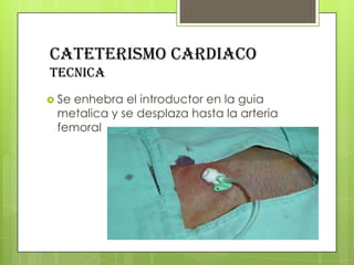CATETERISMO CARDIACO
tecnica
 Se

enhebra el introductor en la guia
metalica y se desplaza hasta la arteria
femoral

 