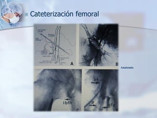 ◼ Cateterización femoral
Anatomía
 