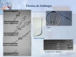 Técnica de Seldinger
Aguja de Punción
Guia
Introductor 5F + Dilatador
 
