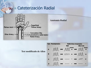 ◼ Cateterización Radial
Anatomía Radial
Test modificado de Allen
 