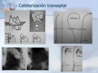 ◼ Cateterización transeptal
 