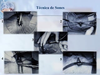 Técnica de Sones
1 2
4
3
5
 